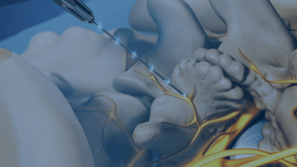 radiofrequency ablation jacksonville fl